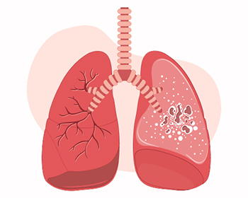 Туберкулез — причины и профилактика