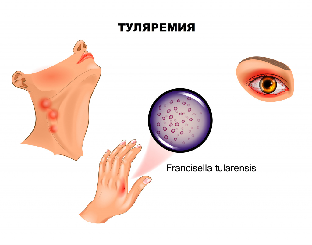 Туляремия