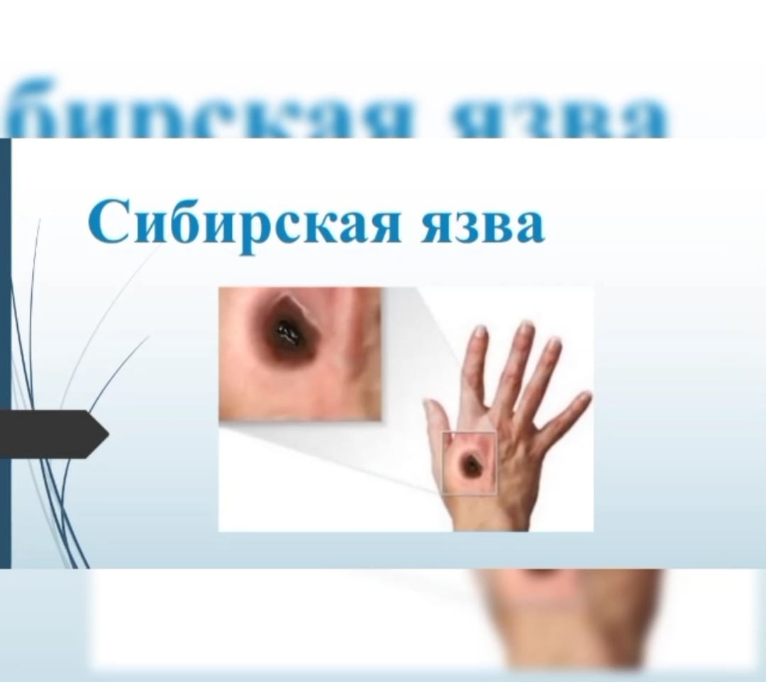Сибирская язва