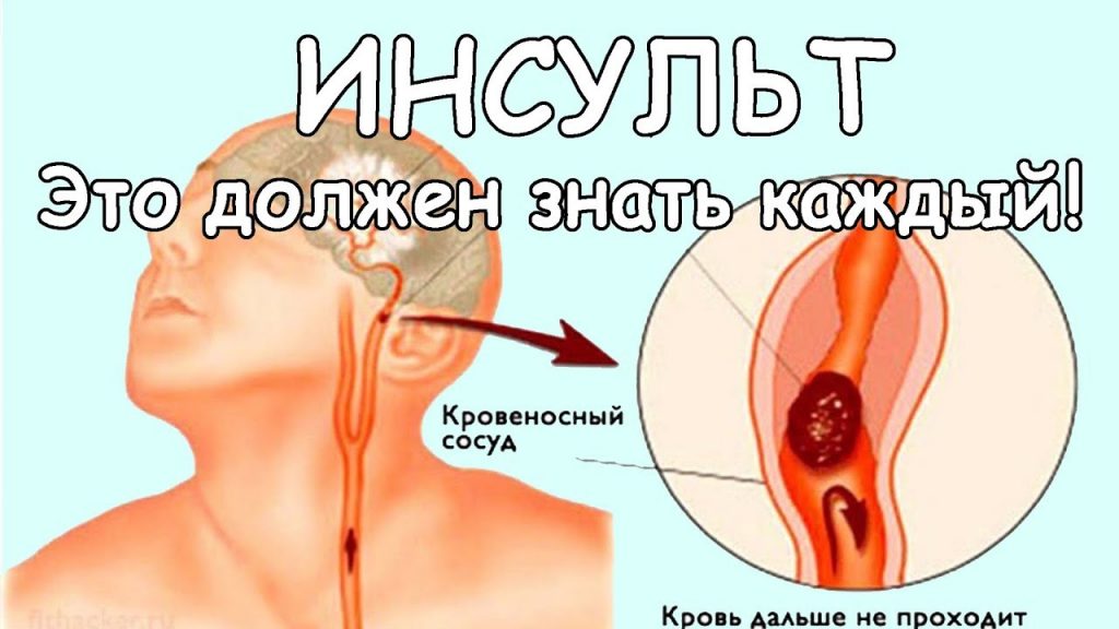 Нейрохирурги сообщают, если в течение 3 часов успеть оказать помощь, то последствий инсульта можно избежать.